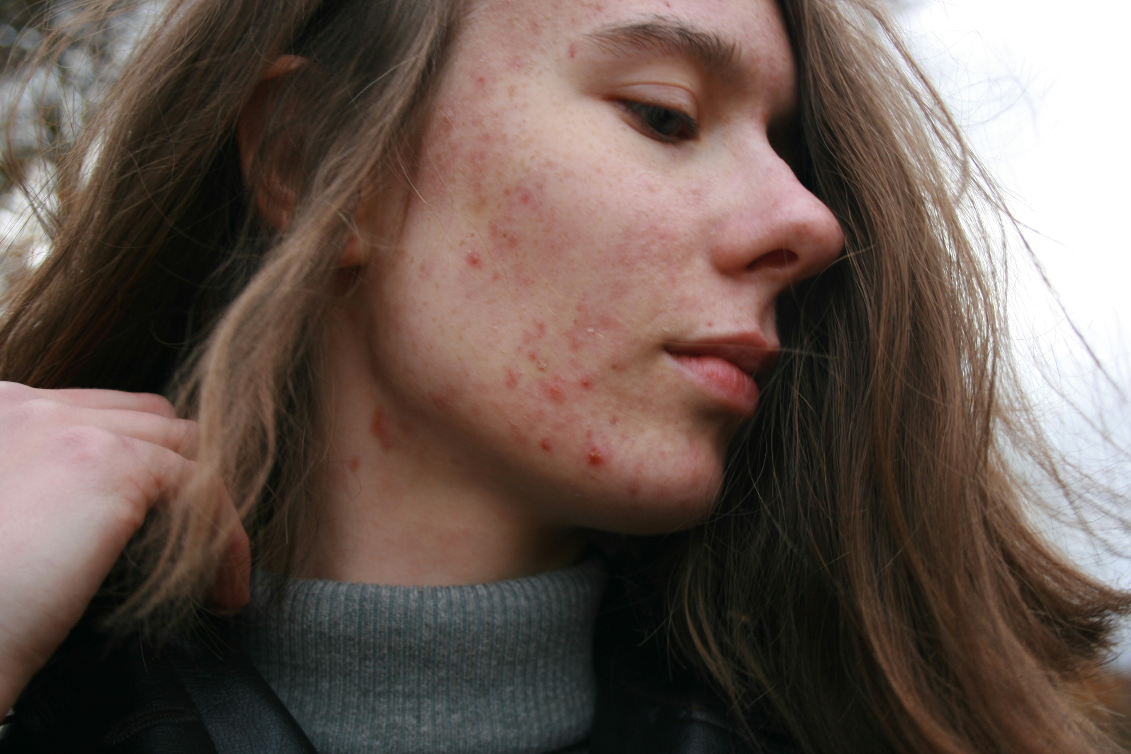 Hormonale acne: oorzaken, symptomen en wat echt helpt
