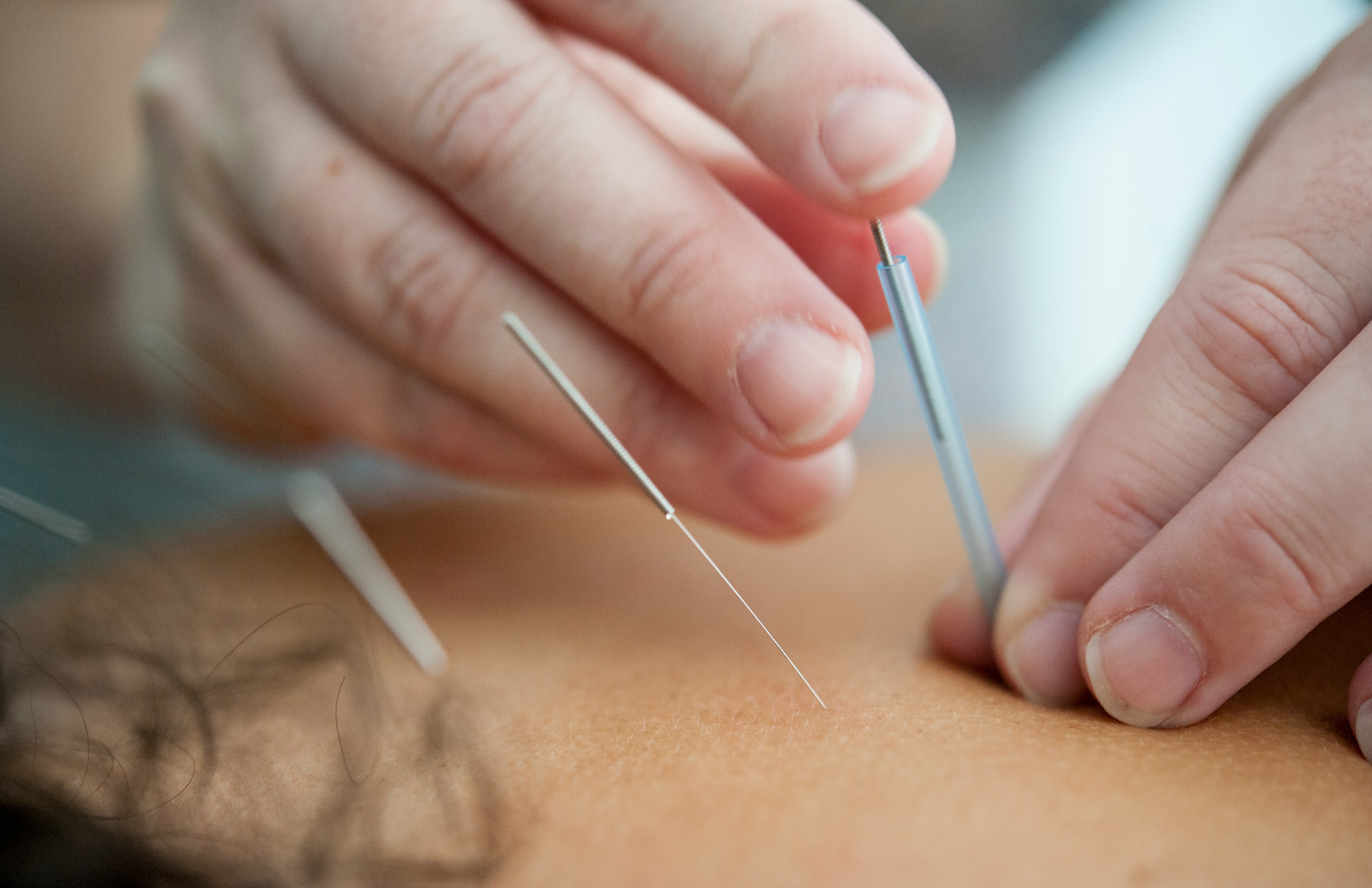 Acupunctuur: balans herstellen met naalden